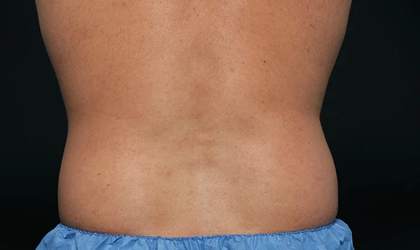 Before CoolSculpting; Photos courtesy of Leyda E. Bowes, MD