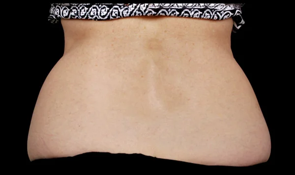 Before CoolSculpting; Photos courtesy of Suzanne Bruce, MD