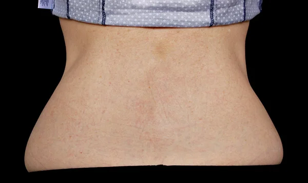 After CoolSculpting; Photos courtesy of Suzanne Bruce, MD - individual results may vary