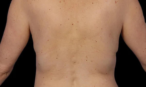 After CoolSculpting; Photos courtesy of Grant Stevens, MD - individual results may vary