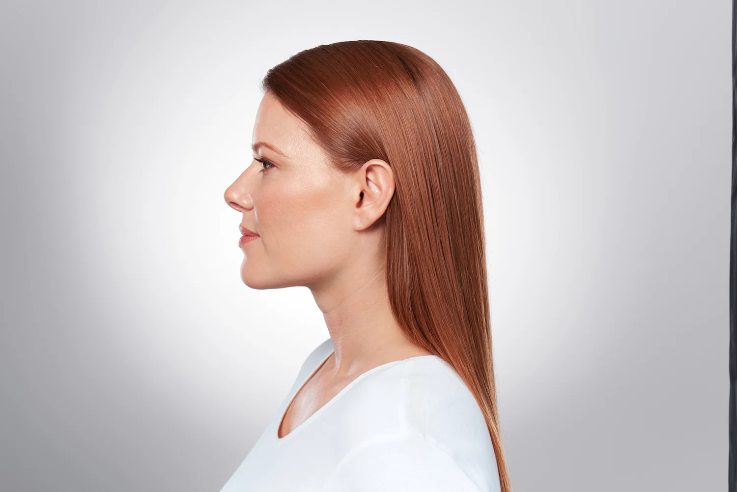 After 3 Kybella Treatments