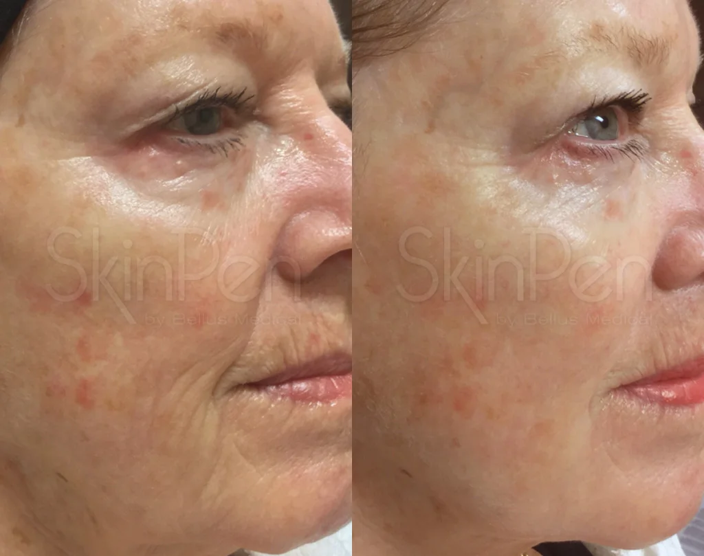 Gender: female / Age: 72 / Treatments: 2 / Frequency: monthly