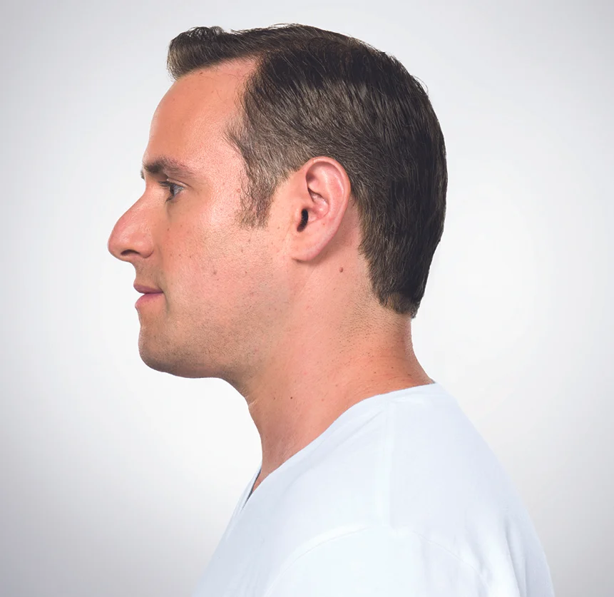 After 6 Kybella Treatments