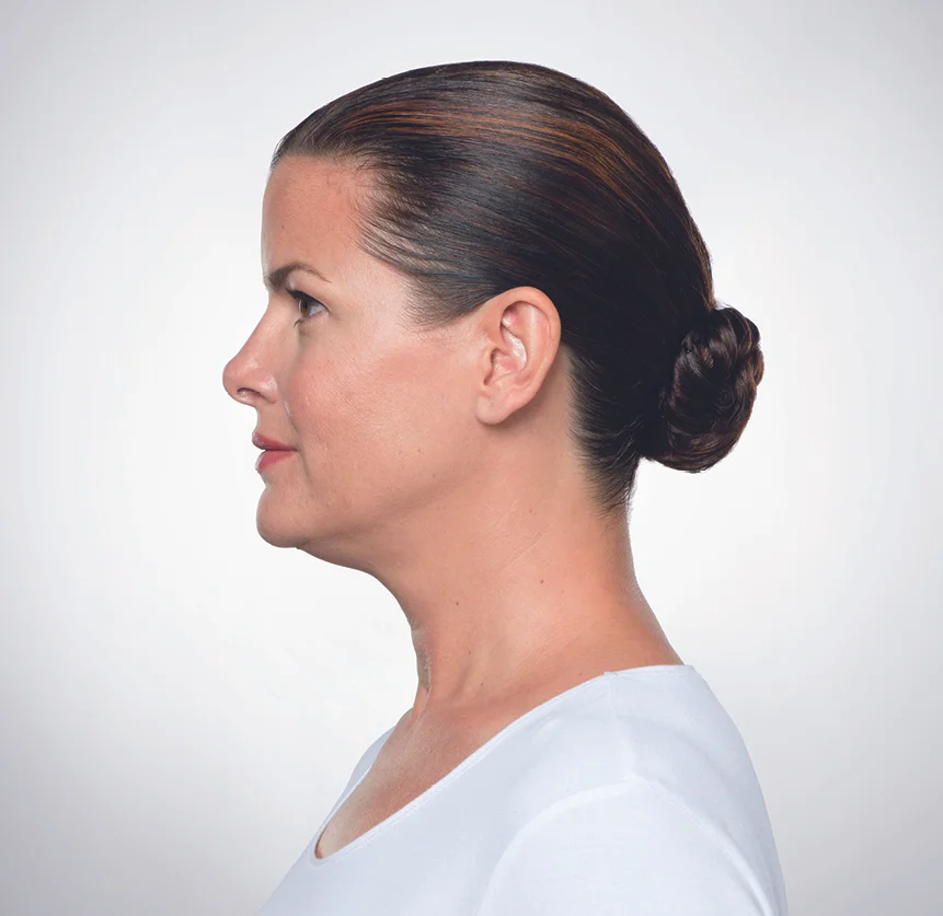 Pre-Kybella Treatments