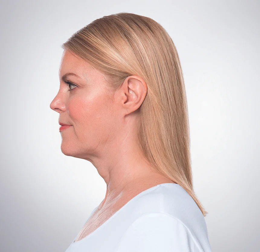 After 4 Kybella Treatments