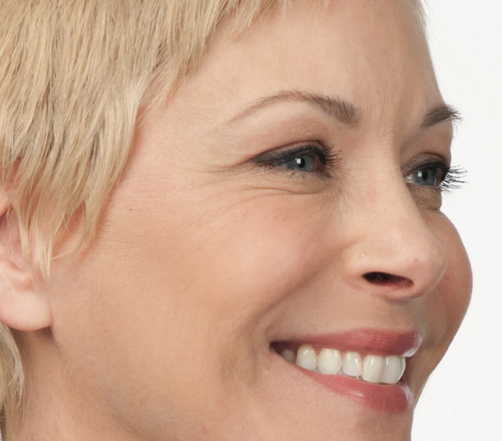 After Botox (Angie, 50)