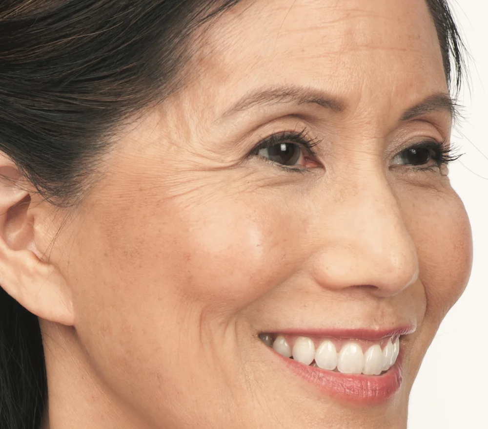 Before Botox