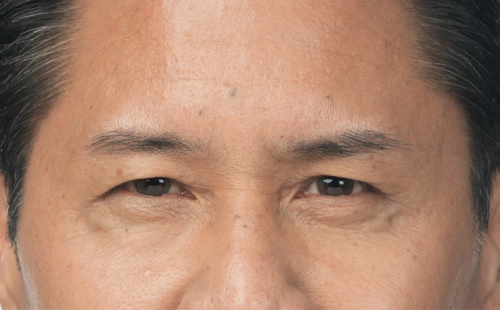 After Botox (Clint, 54)