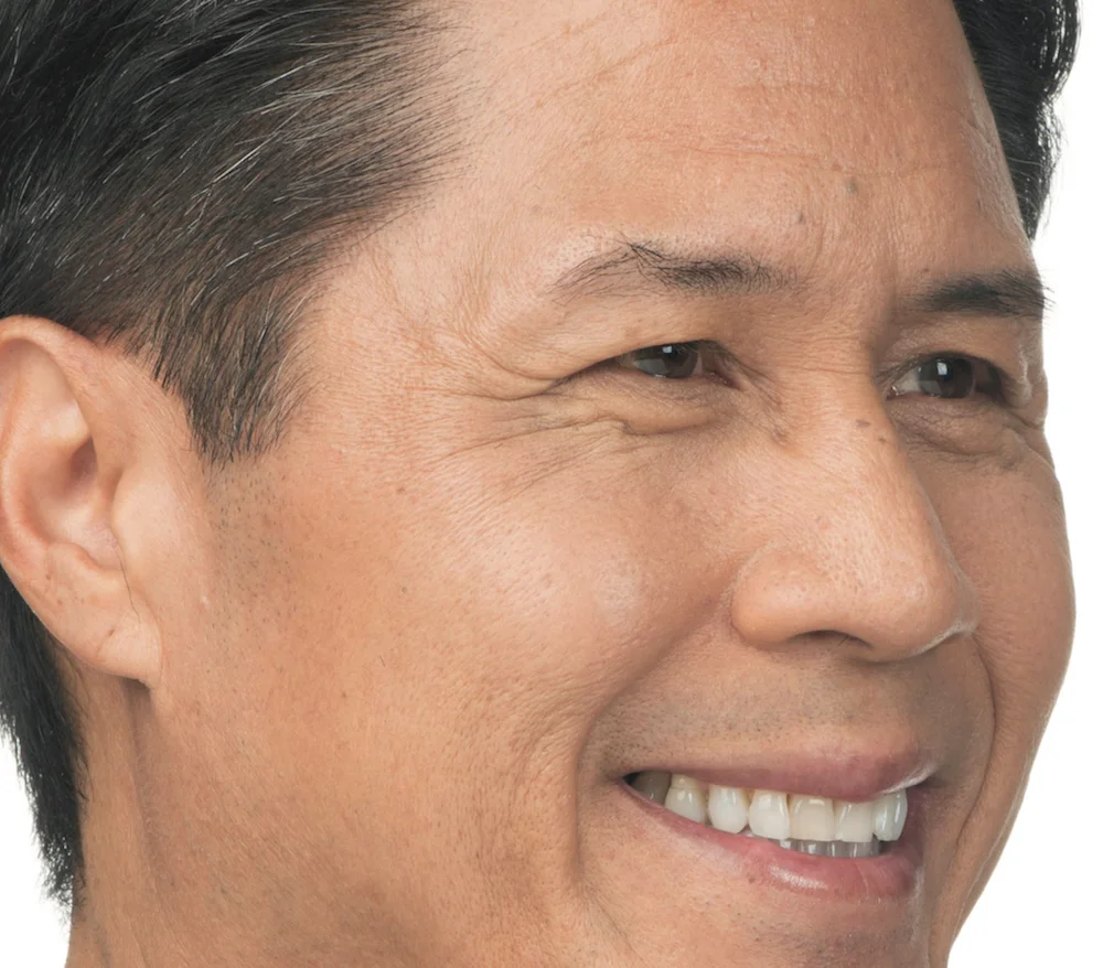 Before Botox (Clint, 54)