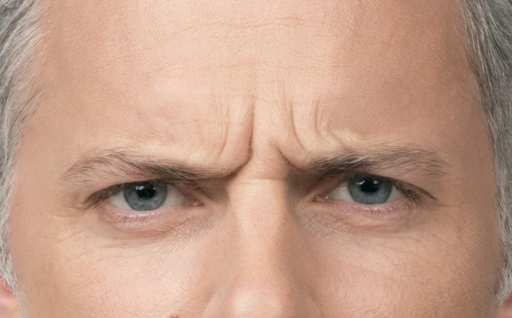 Before Botox (Max, 40)
