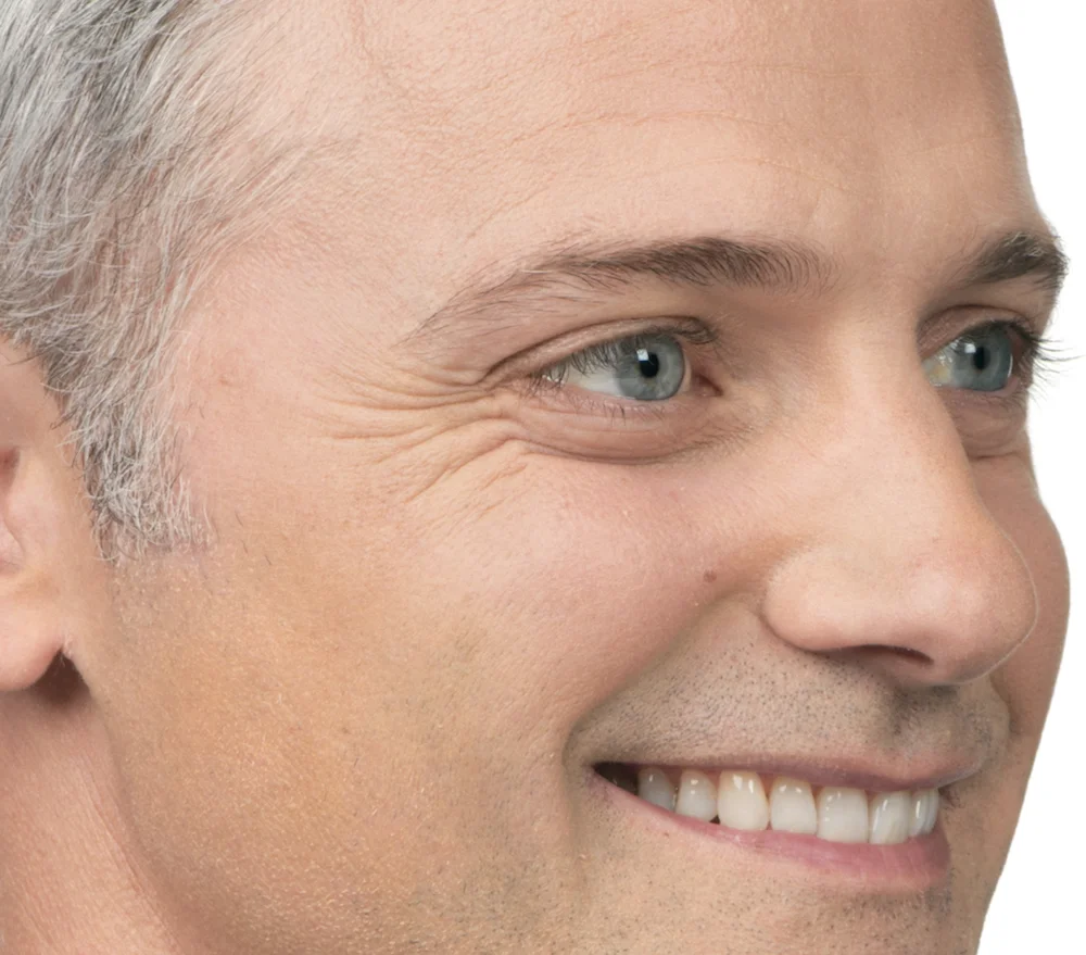 Before Botox (Max, 40)