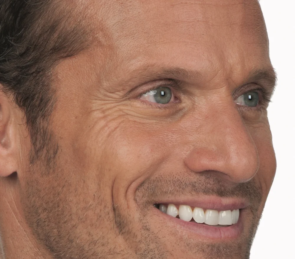 Before Botox (Stephen, 44)