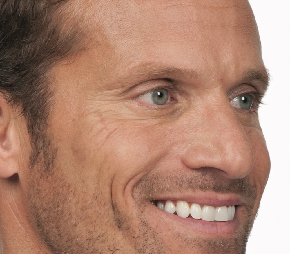 After Botox (Stephen, 44)