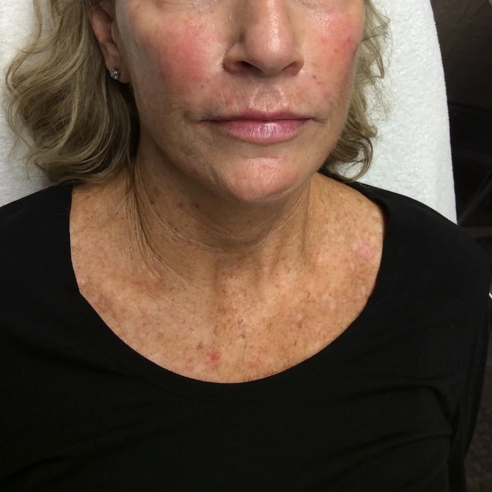 Pure Luxe Patient after Voluma and Juvéderm