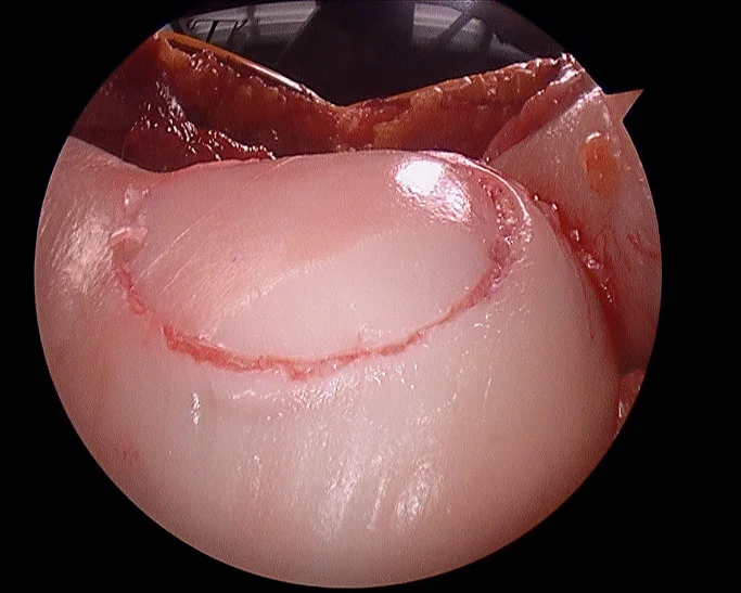 cartilage-replacement2.jpg