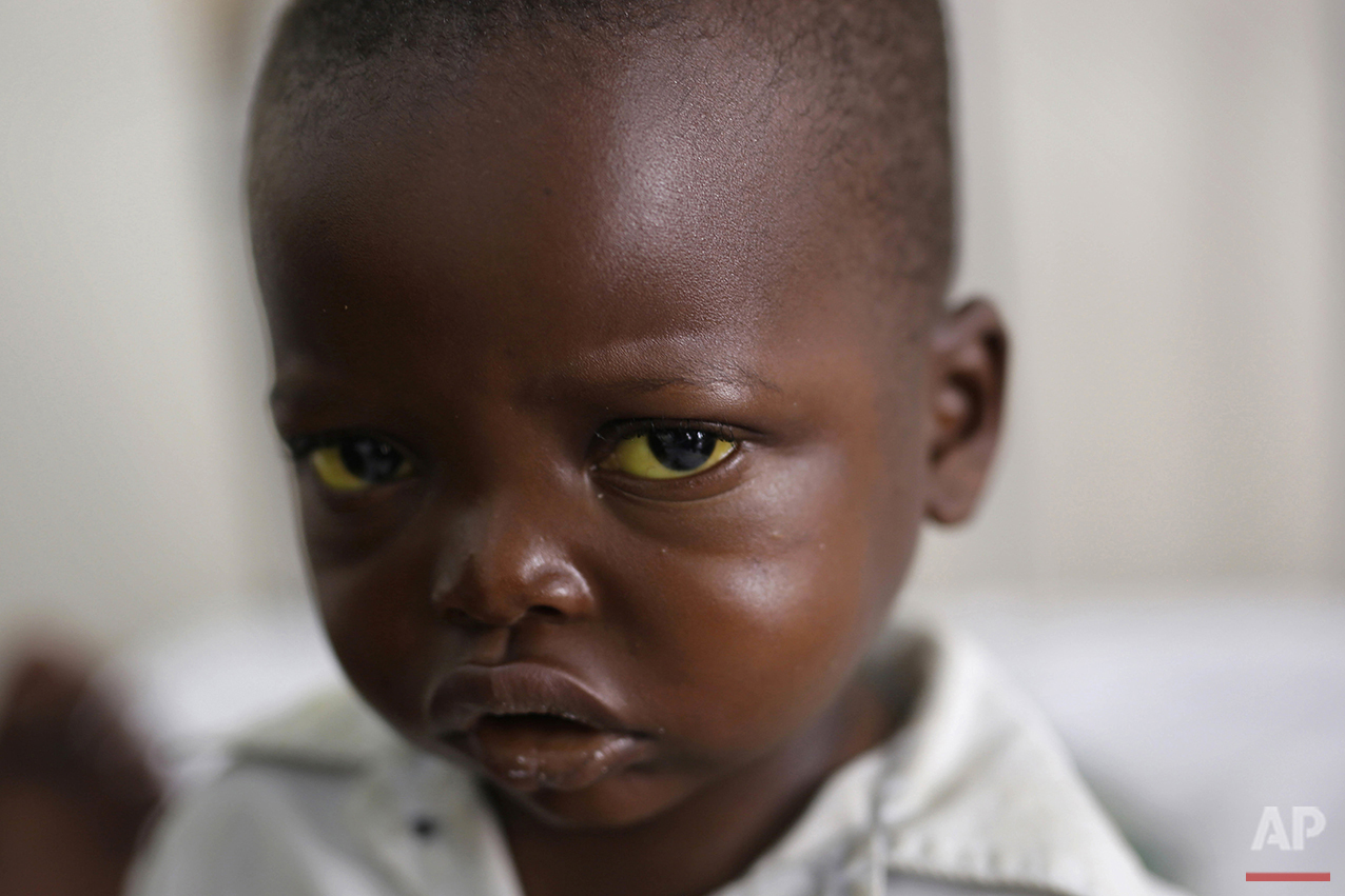  In this photo taken Tuesday July 19, 2016, Jonathan Kangu, 3, sits on his hospital bed in Kinshasa, Democratic Republic of Congo, after contracting symptoms of yellow fever. He’s been sick for two weeks and while his eyes have now turned a glowing s