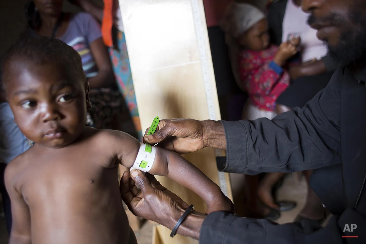  In this Feb. 15, 2016 photo, community health volunteer Sylvio Fils-Aime examines a child for signs of malnutrition, in Oriani, Haiti. Many Haitians routinely go to bed hungry. But the impact of a yearlong drought is so severe that Haiti is facing "