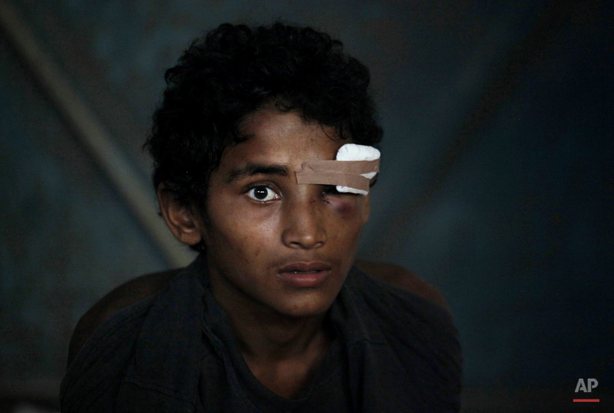  In this Friday, May 15, 2015, photo, a newly arrived ethnic Rohingya youth, who said he was injured in the eye during a brawl on the boat, sits inside a temporary shelter at Kuala Langsa Port in Langsa, Aceh province, Indonesia. More than 2,000 desp