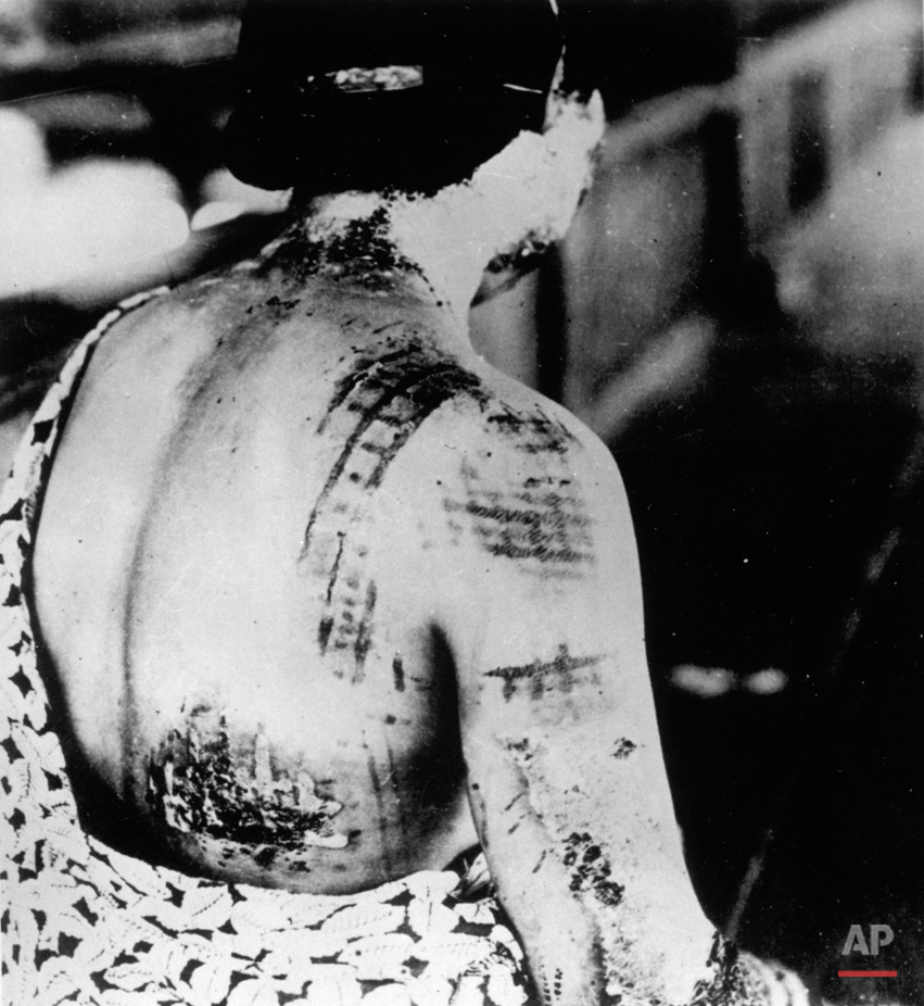  A victim of the first atomic bomb ever used in warfare is seen in September 1945, at the Ujina Branch of the First Army Hospital in Hiroshima. The thermic rays emitted by the explosion burned the pattern of this woman's kimono upon her back. (AP Pho