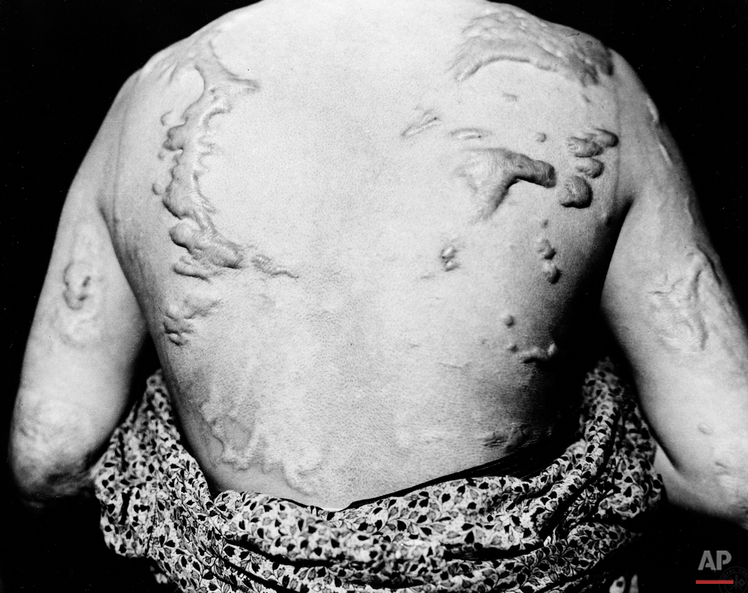  Ikimi Kikkawa shows keloid scars following the healing of burns caused by the atomic bomb dropped on Hiroshima at the end of the second World War.  She was seen at the Red Cross hospital there, June 5, 1947.  (AP Photo) 