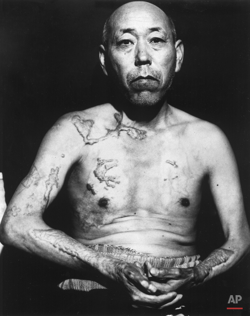  A survivor of the first atomic bomb ever used in warfare, Jinpe Teravama retains scars after healing of burns from the bomb explosion, Hiroshima, in June 1947. (AP Photo) 