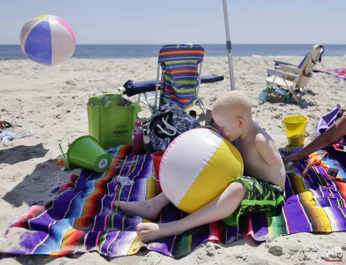 Albino Children: Receiving Prosthetics