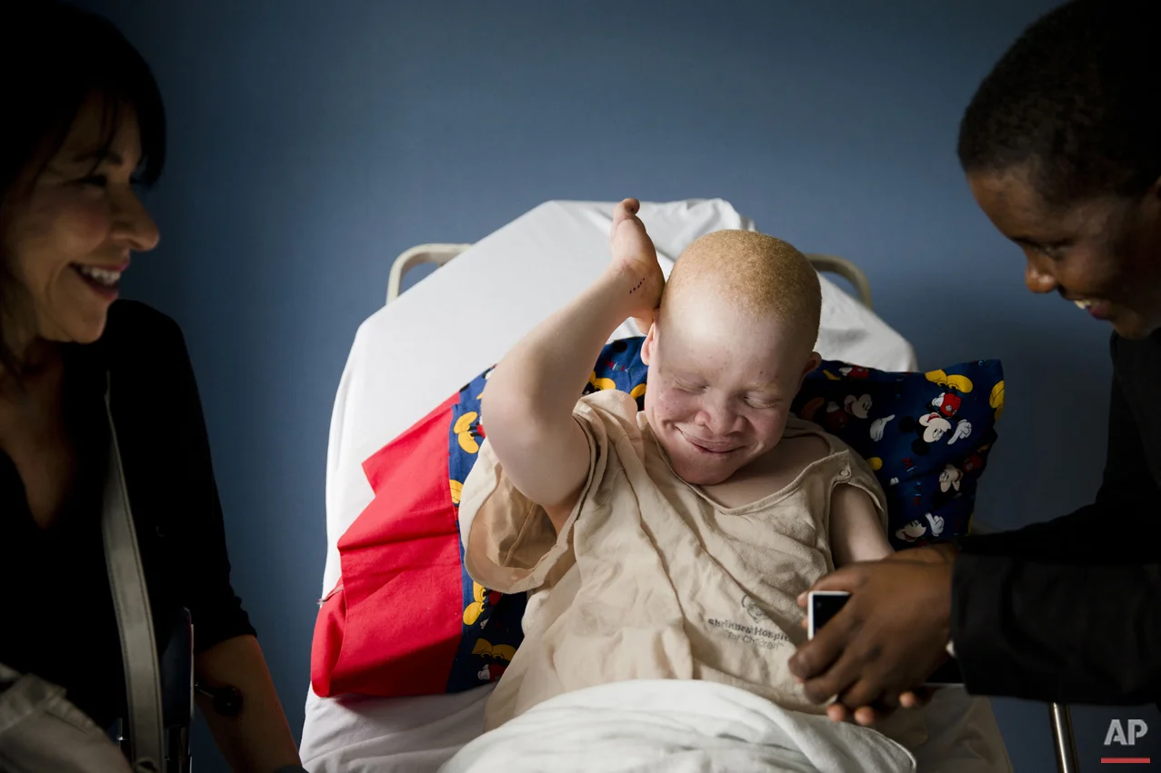 Albino Children: Receiving Prosthetics