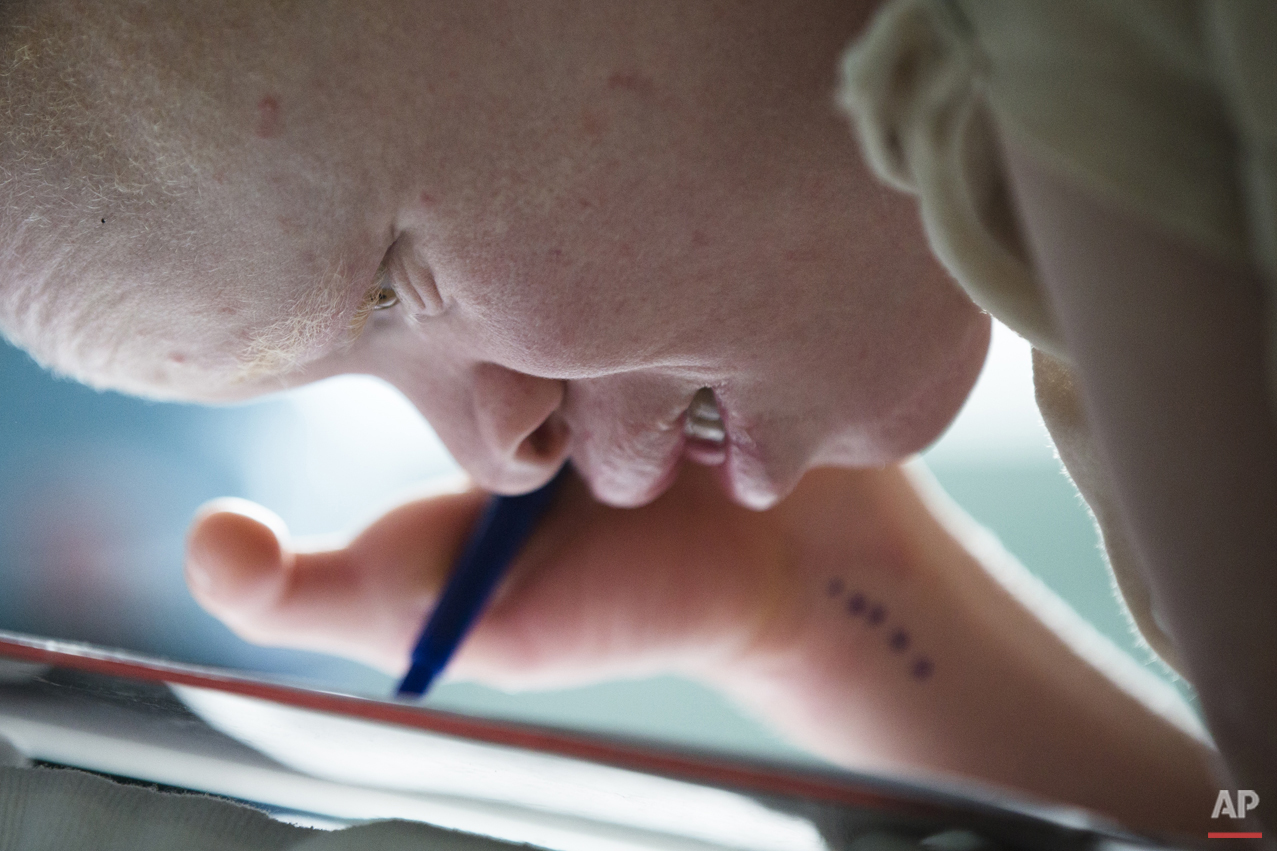 Albino Children: Receiving Prosthetics