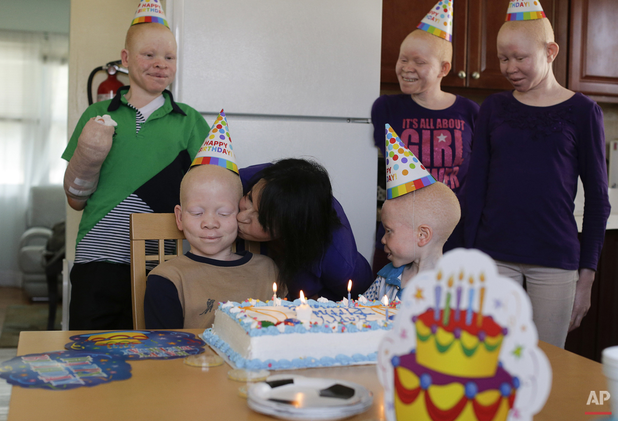 Albino Children: Receiving Prosthetics