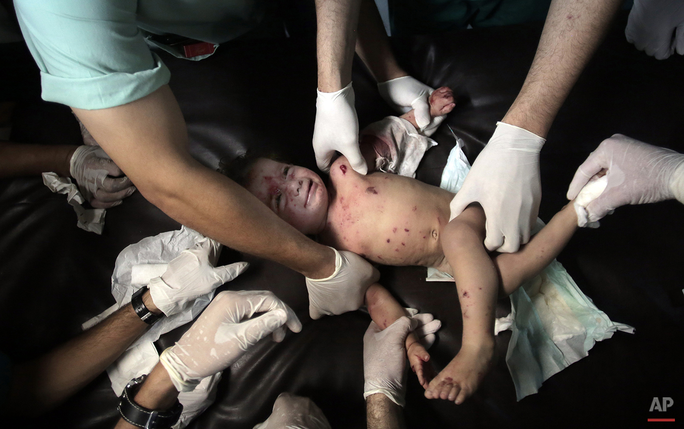  In Friday, July 18, 2014 photo, Palestinian medics treat 13-month-old Anwar Saad at the emergency room of the Shifa hospital in Gaza City, northern Gaza Strip. Screaming, covered in red burns and welts from shrapnel, Saad’s fear and pain showed acro