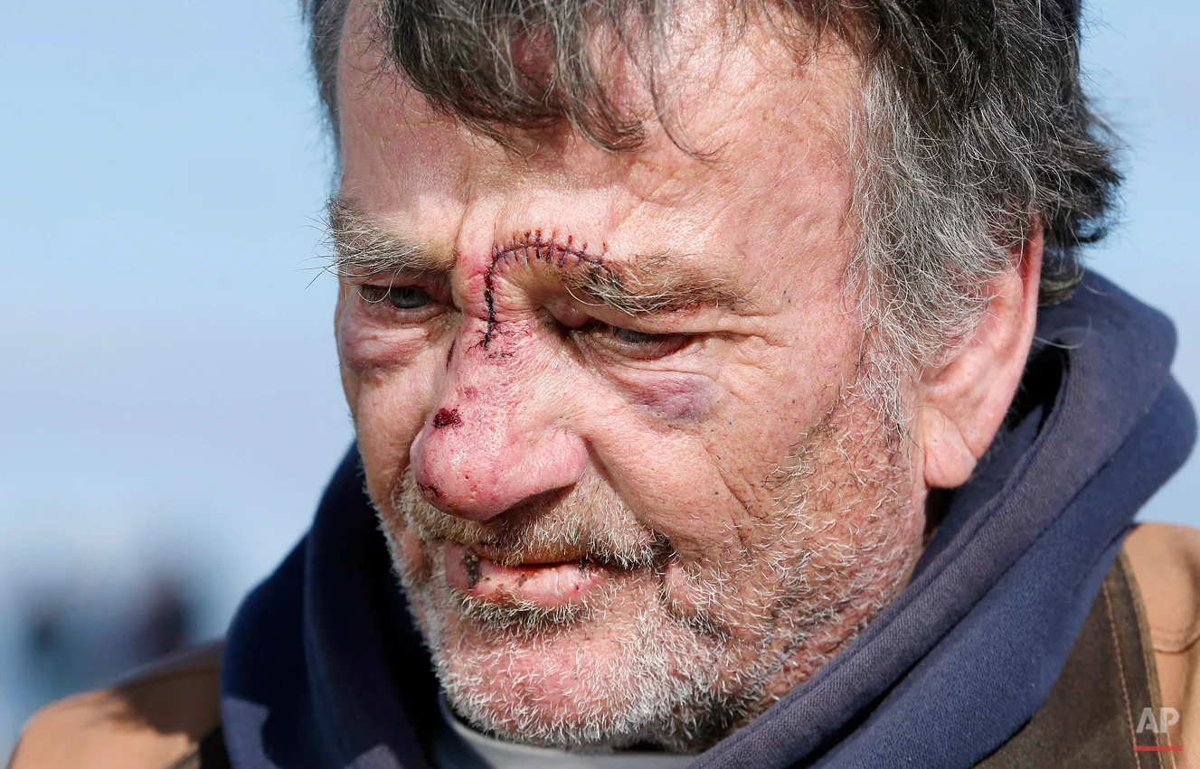 Tim Mannix pauses while speaking to reporters in front of his house in Marshfield, Mass., Wednesday, Jan. 28, 2015. Mannix was injured Tuesday when a wave shattered a window during a winter storm that buried the Boston area in more than 2 feet of snow. (AP Photo/Michael Dwyer)