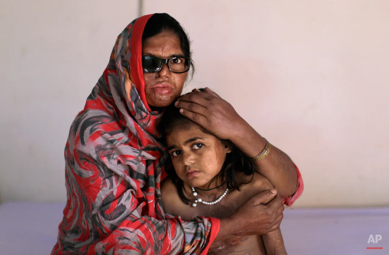 Pakistani acid attack survivor, Azim Mai, 35, holds her daughter Shaziya, 8, while sitting on a bed waiting to have a massage session for their wounds, at the Acid Survivors Foundation (ASF) in Islamabad, Pakistan, Tuesday, Dec. 13, 2011. Azim Mai's husband allegedly threw acid in her face and their daughter Shaziya last year after she refused to sell their two boys to a man in Dubai to use as camel racers. Rights activists Tuesday praised the laws, which stiffened the punishment for acid attacks and also criminalized practices such as marrying off young girls to settle tribal disputes and preventing women from inheriting property. The Senate provided final approval for two bills containing the new laws Monday. (AP Photo/Muhammed Muheisen)