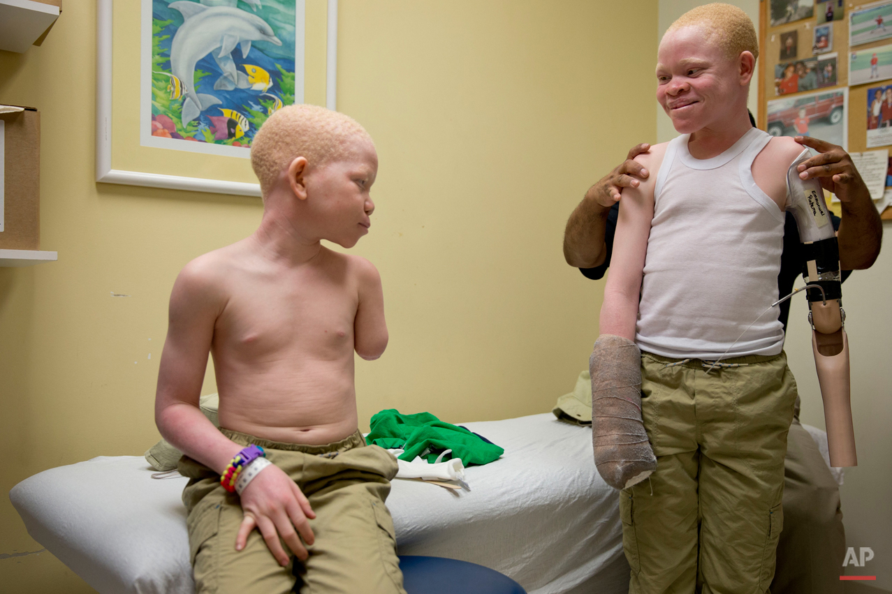  Mwigulu Magesa,12, left, and Emmanuel Rutema, 13, both of Tanzania and who have Albinism are fitted prosthetic limbs, Thursday, July 23, 2015, at Shriners Hospital for Children in Philadelphia. Magesa, Rutema, and three other children also with Albi