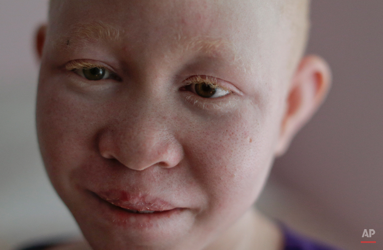  Pendo Noni takes a break in her room in New York on Wednesday, July 1, 2015. One out of every 1,400 citizens in Tanzania has albinism. Pendo and four other children also with albinism are in the U.S. to receive free surgery and prostheses at a hospi