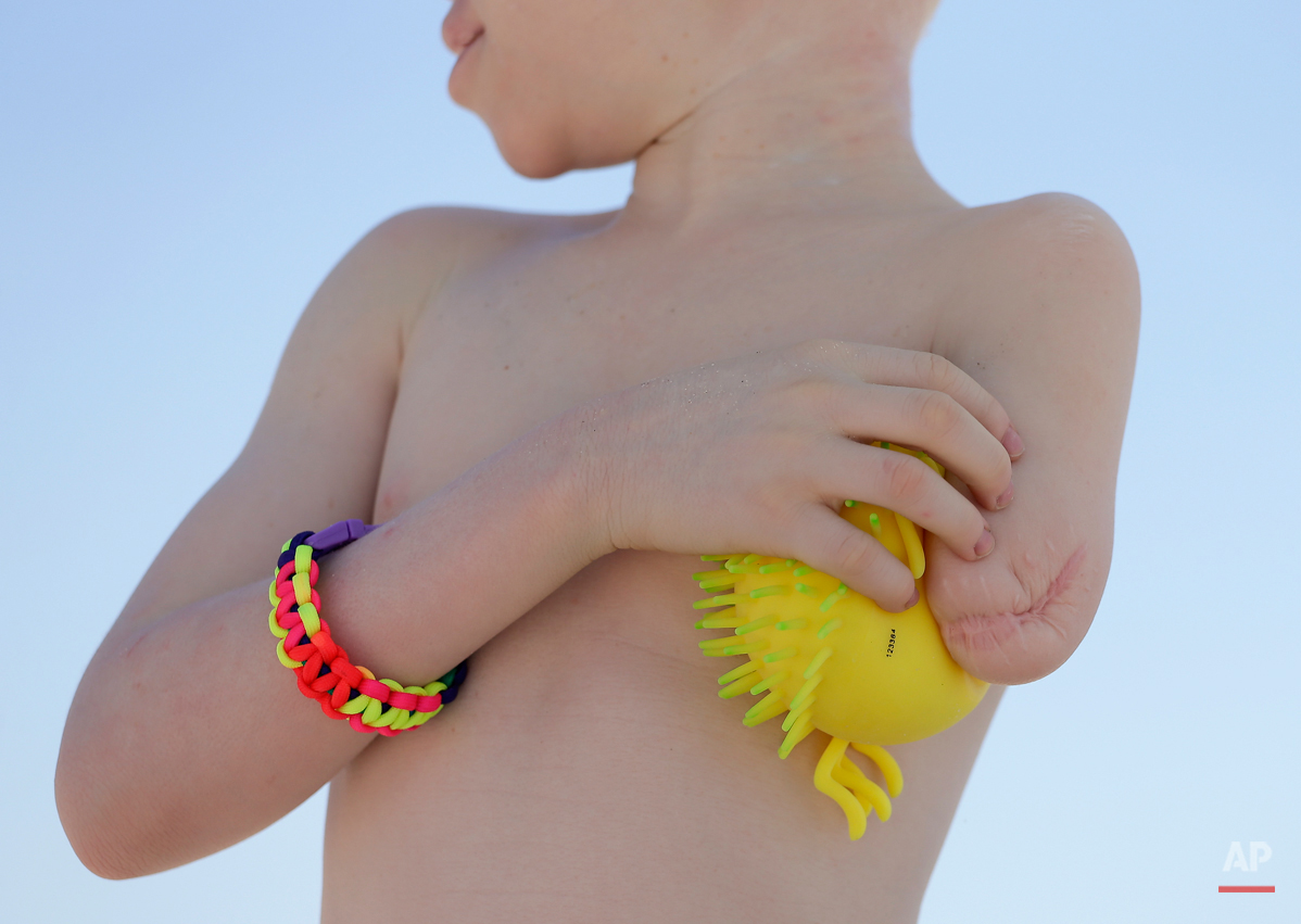  Mwigulu Magesa holds a water toy between his body and his amputated left arm while playing on a beach in Long Beach Island, N.J. on Wednesday, July 22, 2015. One out of every 1,400 citizens in Tanzania has albinism. Mwigulu was attacked and dismembe