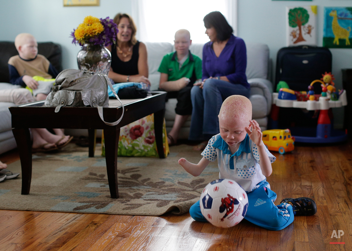 Baraka Lusambo, 5, plays with a new soccer ball in New York on Wednesday, July 1, 2015. Lusambo and four other children also with albinism are in the U.S. to receive free surgery and prostheses at the hospital. One out of every 1,400 citizens in Tan