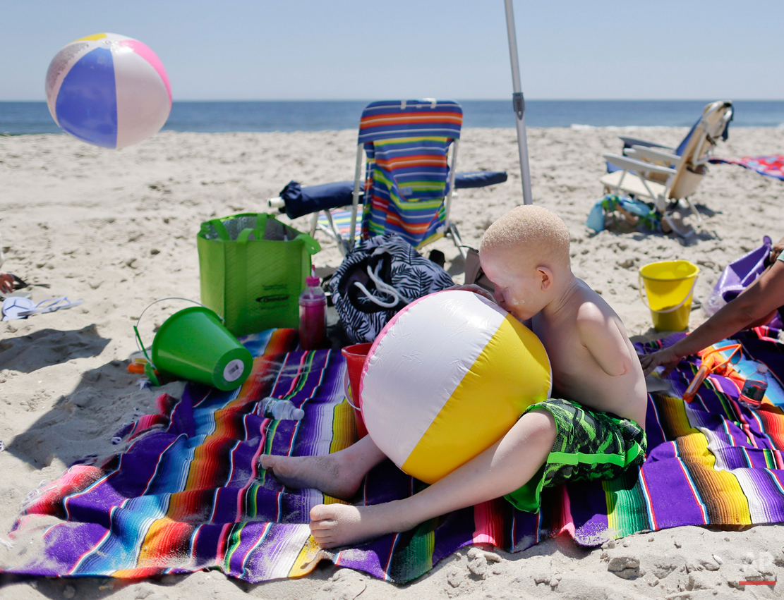  Mwigulu Magesa blows up a beach ball while playing on a beach in Long Beach Island, N.J. on Wednesday, July 22, 2015. People with the genetic condition, characterized by a lack of pigment, are often referred to in Tanzania as ghosts, or zero zero, w