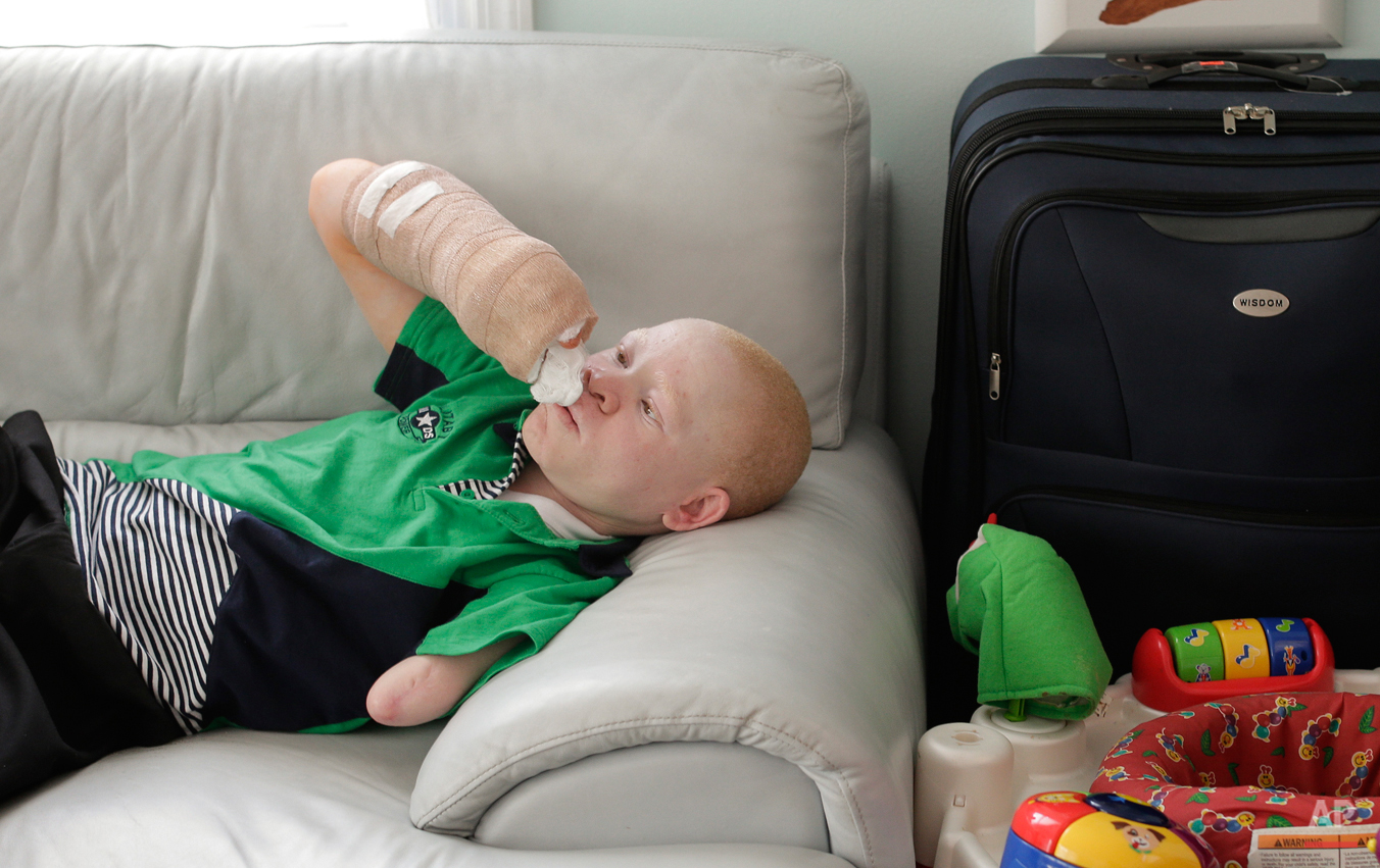  Emmanuel Rutema examines his right arm after surgery to attach one of his toes to his hand, Wednesday, July 1, 2015, in New York. Rutema and four other children also with albinism are in the U.S. to receive free surgery and prostheses at the hospita