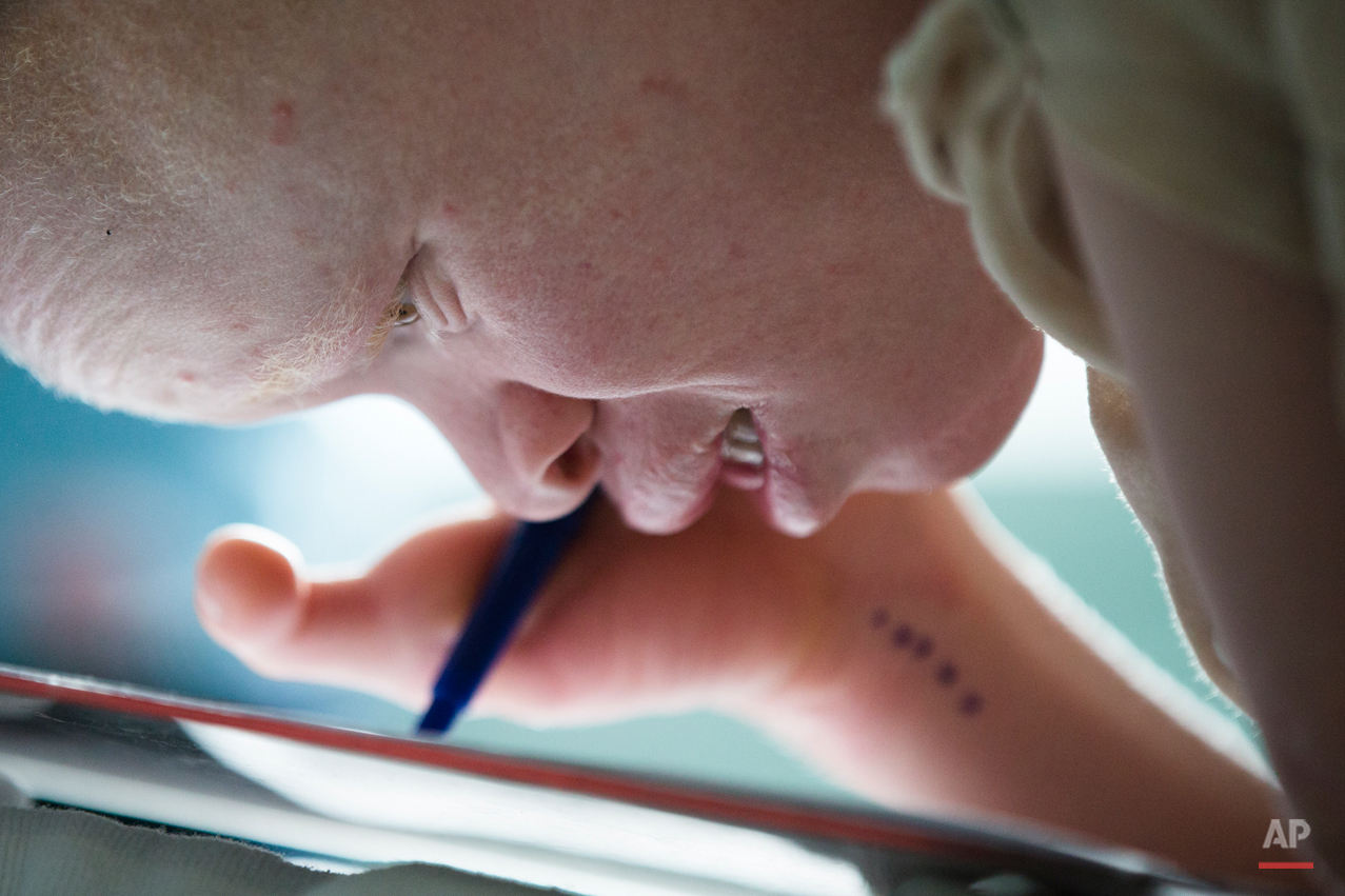  Emmanuel Rutema, 13, of Tanzania, with the hereditary condition of albinism, draws a picture on a clipboard before of his surgery at Shriners Hospital for Children in Philadelphia on Tuesday, June 30, 2015. The lack of pigments in parts of the eyes 