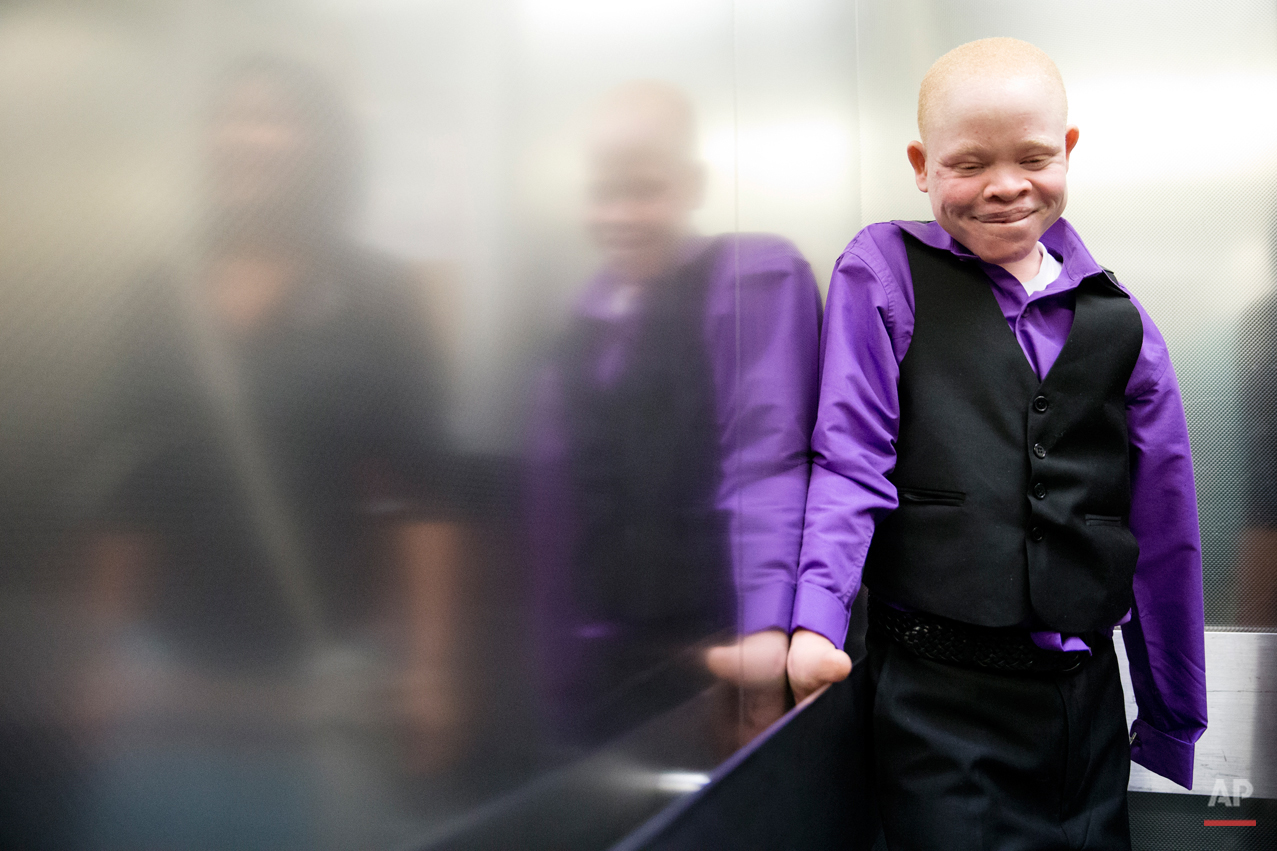  Emmanuel Rutema, 13, of Tanzania rides an elevator ahead of his surgery Tuesday, June 30, 2015, at Shriners Hospital for Children in Philadelphia. Rutema and four other children also with the hereditary condition of albinism are in the U.S. to recei
