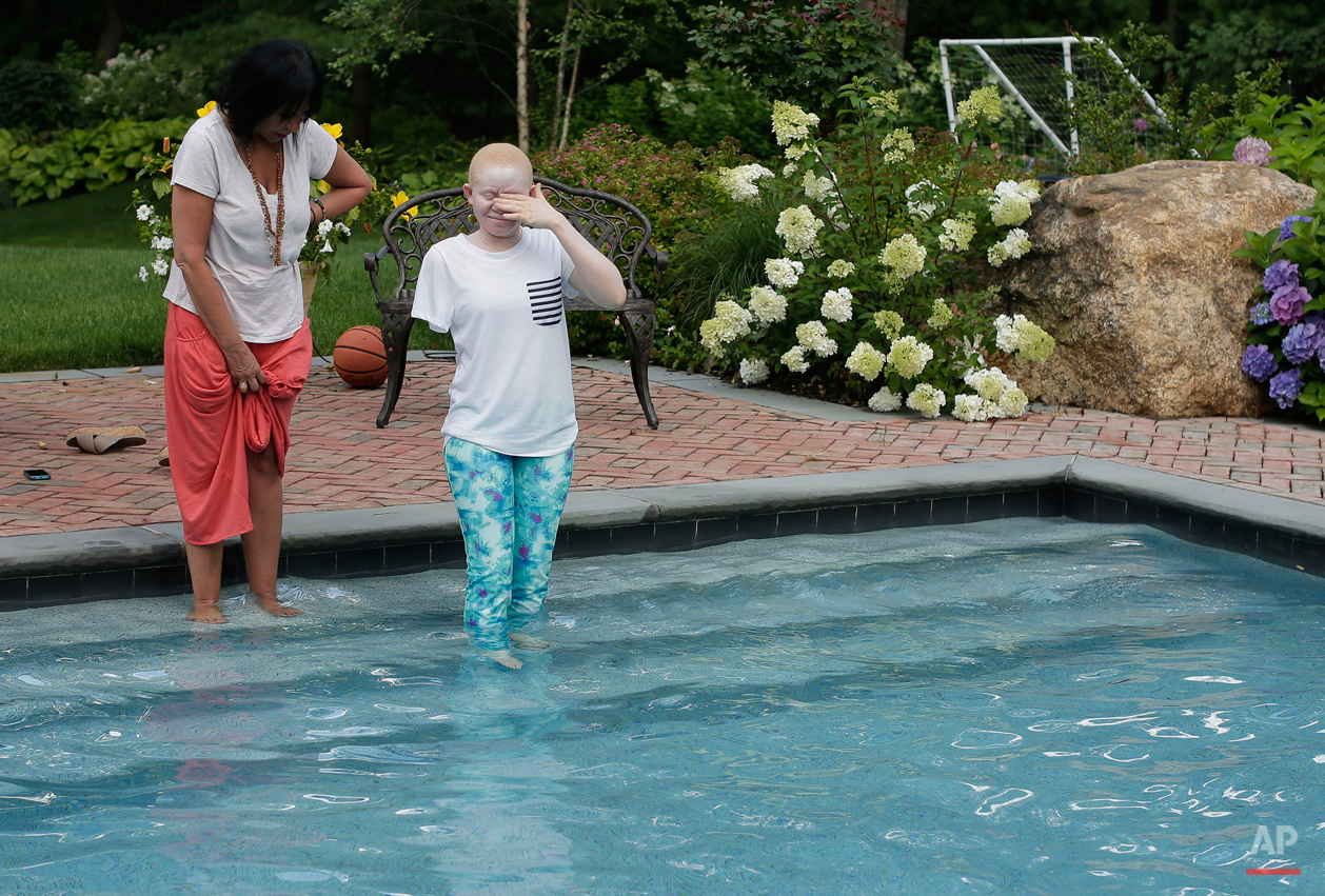  Kabula Masanja, right, of Tanzania, closes her eyes as she steps into a swimming pool for the first time with the encouragement of Elissa Montanati, founder and director of Global Medical Relief Fund, at a home in Oyster Bay, N.Y. on Monday, July 20