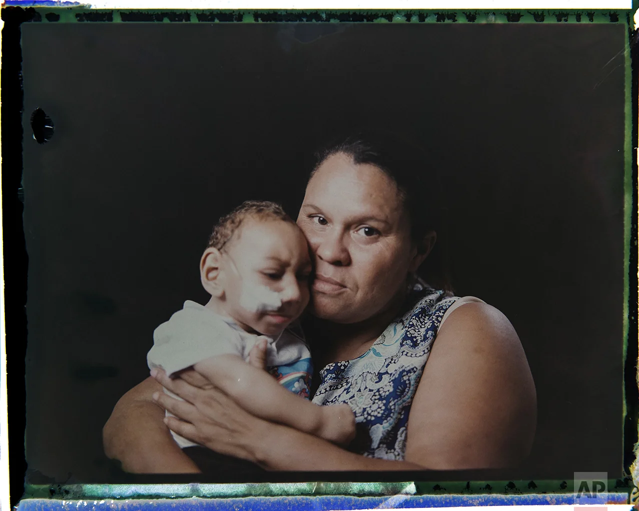 In this Sept. 27, 2016 photo made from a negative recovered from instant film, Solange Ferreira holds her 1-year-old son Jose Wesley Campos, who was born with microcephaly, one of many serious medical problems that can be caused by congenital Zika syndrome, as they pose for a photo in Bonito, Pernambuco state, Brazil. The boy came to be known as the "bucket baby" because of a Dec. 23, 2015 photograph of him in a bucket filled with water to help him calm down. The image became emblematic of Brazil's Zika epidemic amid a surge of babies being born with unusually small heads in the country's northeast. (AP Photo/Felipe Dana)