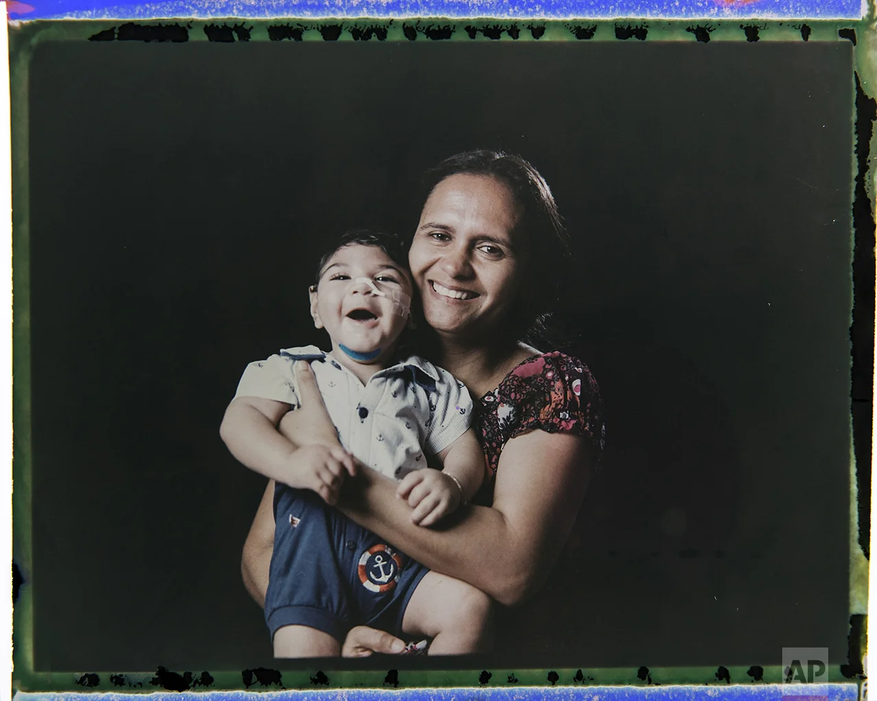 In this Sept. 29, 2016 photo made from a negative recovered from instant film, Rozilene Ferreira poses with her 1-year-old son, Arthur Conceicao, who was born with microcephaly, one of many serious medical problems that can be caused by congenital Zika syndrome, in Recife, Pernambuco state, Brazil. A year after a spike in the number of newborns with the defect known as microcephaly, Brazilian doctors and researchers have seen many of the babies develop swallowing difficulties, epileptic seizures and vision and hearing problems. (AP Photo/Felipe Dana)