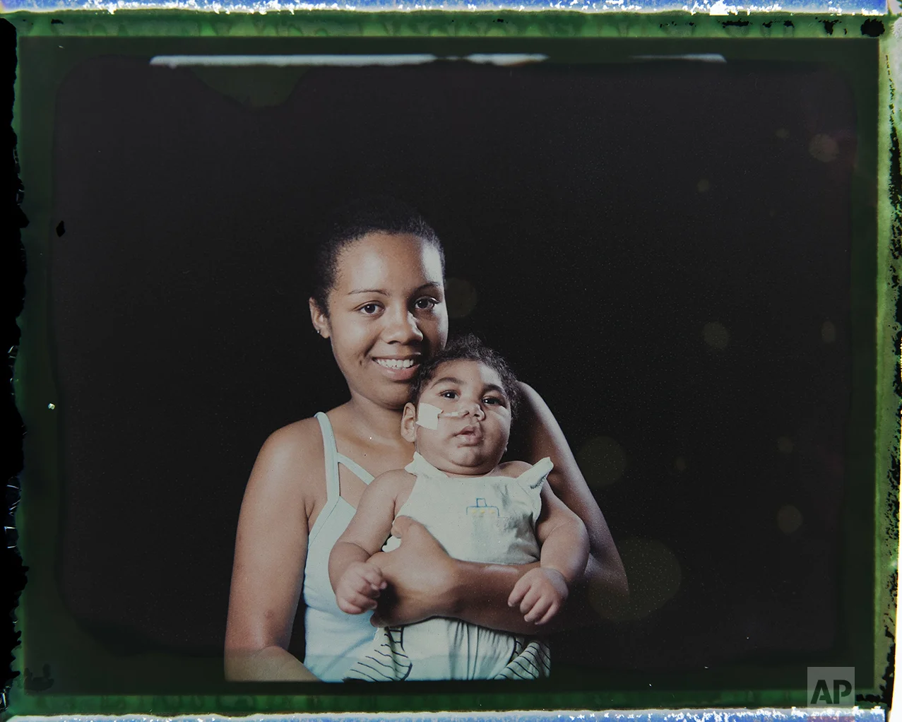 In this Sept. 29, 2016 photo made from a negative recovered from instant film, Tatiane do Nascimento holds her son Willamis Silva, who was born with microcephaly, one of many serious medical problems that can be caused by congenital Zika syndrome, as they pose for a photo in Recife, Pernambuco state, Brazil. Willamis was having swallowing problems and not gaining weight so a feeding tube was introduced, which in less than a month he pulled out a couple of times. Barbosa, who has two other children, says she used to take Williamis daily to the hospital or physical therapy, but now they are going two or three times a week. (AP Photo/Felipe Dana)