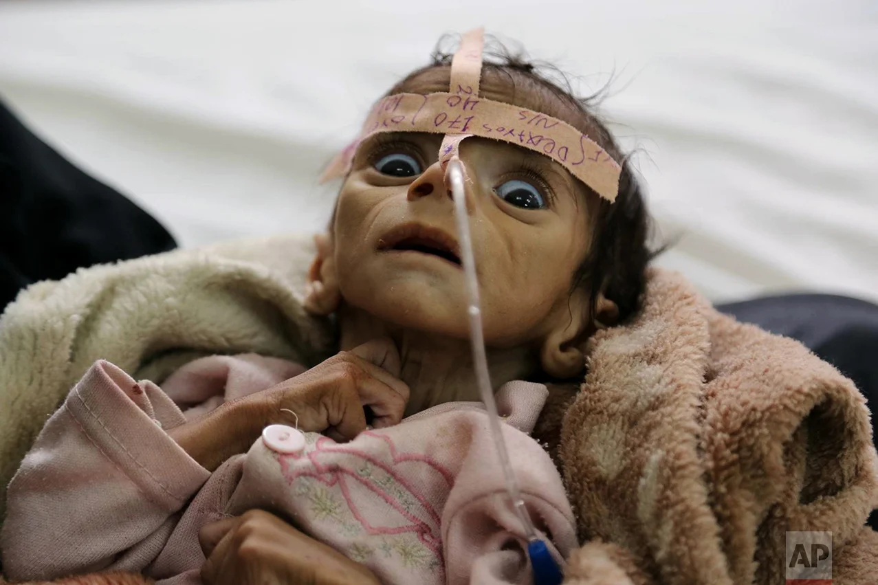Udai Faisal, an infant who is suffering from acute malnutrition, is hospitalized at Al-Sabeen Hospital in Sanaa, Yemen, on March 22, 2016. Udai died on March 24. Hunger has been the most horrific consequence of Yemen's conflict and has spiraled since Saudi Arabia and its allies, backed by the U.S., launched a campaign of airstrikes and a naval blockade a year ago. (AP Photo/Maad al-Zikry)
