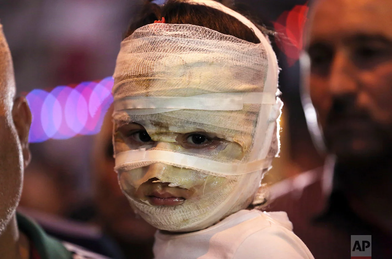 In this Saturday, July 9, 2016 photo, Asal Ahmed, 4, is carried by her father at the scene of a massive suicide truck bomb attack in Karada, Iraq. Asal and her mother were badly burned as they shopped for the Muslim holiday of Eid al-Fitr. (AP Photo/Hadi Mizban)