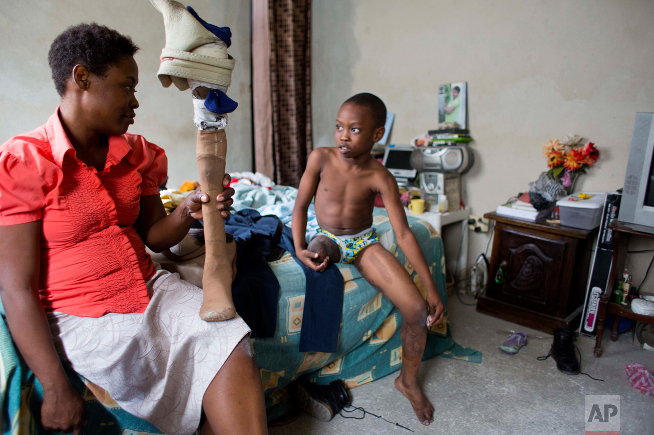 In this Jan. 10, 2017 photo, Judeley Hans Debel chats after school with his mother Nerlande Jean Philippe who holds his prosthetic leg, at their home in Petion-Ville, Haiti. The single, unemployed mother struggles to support him and has to do her best maintaining his battered prosthetic leg as he grows because she can't afford a new one. (AP Photo/Dieu Nalio Chery)
