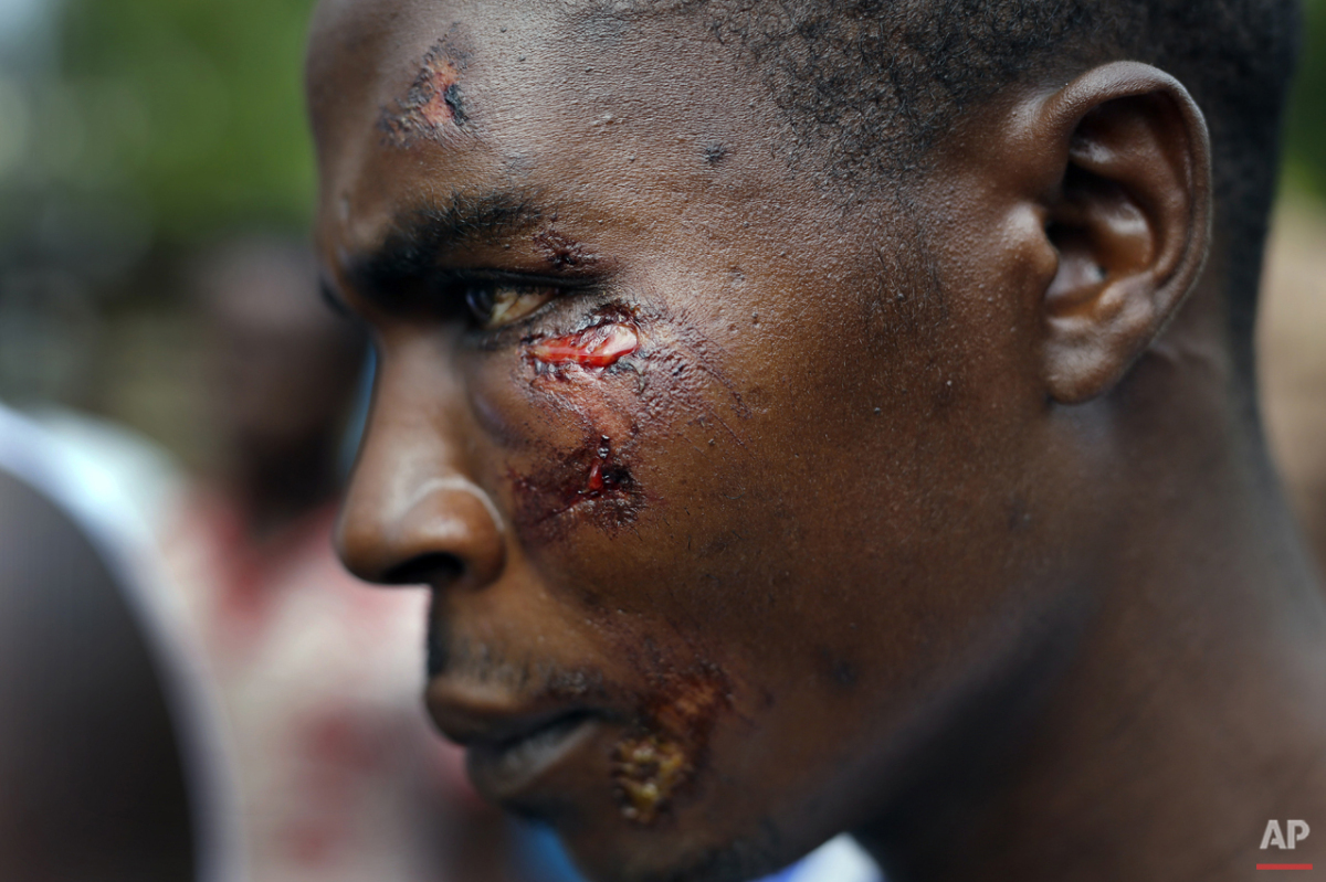  Jafeh Hakizimana shows his wounds in the rural Bujumbura village of Kamesa, Burundi, Monday May 18, 2015. Hakizimana is one of three wounded during an attack of his village by Imbonerakure  pro-government militias. (AP Photo/Jerome Delay) 