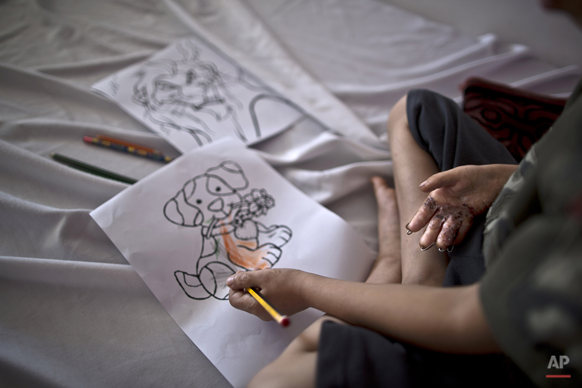  In this Tuesday, Aug. 11, 2015 photo, Syrian boy Mohammed Sarhan, 5, who was injured in 2013 when a shell hit his family's home, draws while sitting on his bed at MSF Hospital for Specialized Reconstructive Surgery in Amman, Jordan. Mohammed was sti