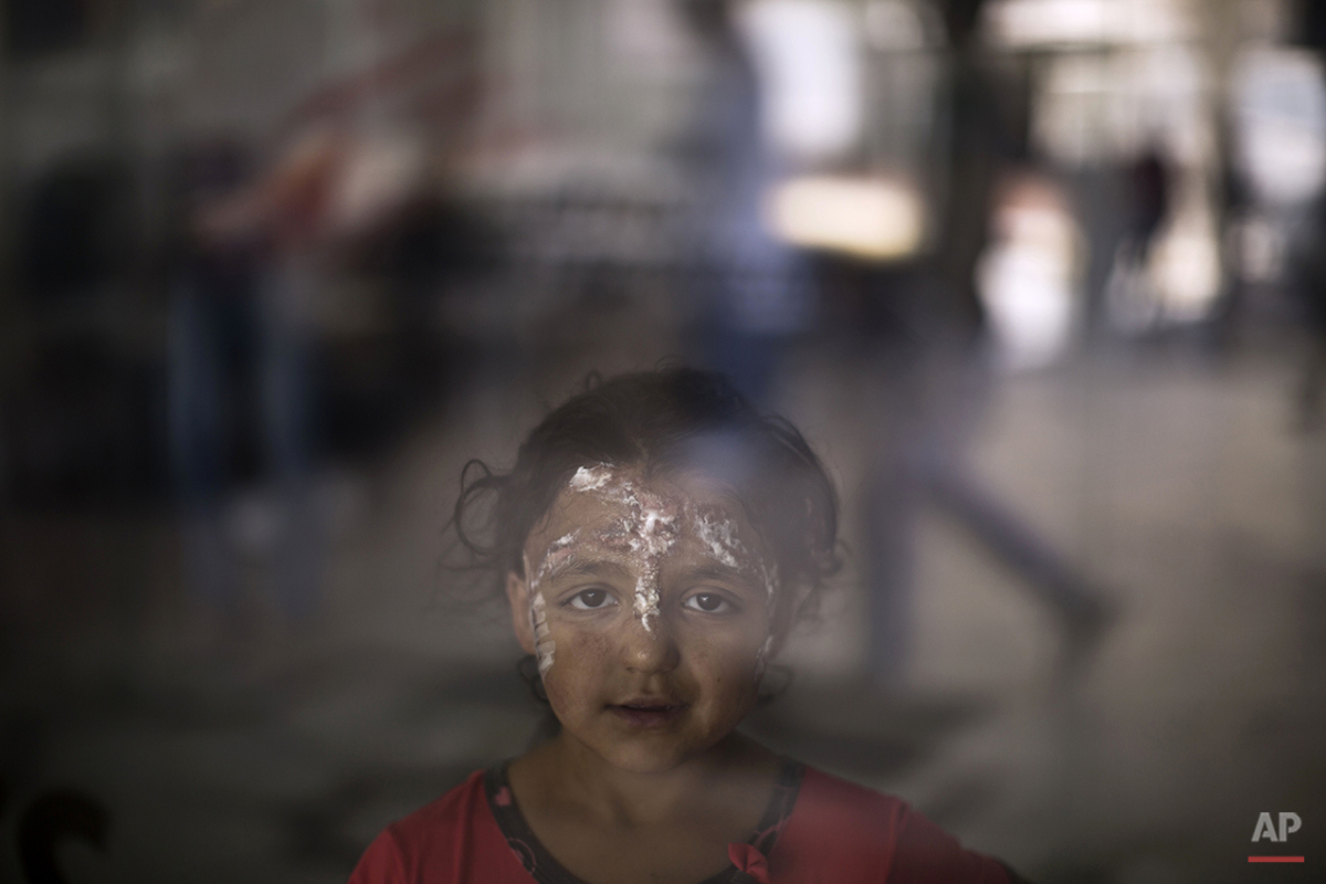  In this Monday, Aug. 17, 2015 photo, Syrian girl Rahaf Kaddour, 5, who was burnt in an explosion that hit her home, poses for a picture at MSF Hospital for Specialized Reconstructive Surgery in Amman, Jordan. In Syria alone, more than 1 million have